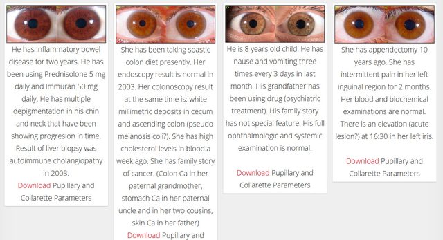Case cards, each with a pair of iris photographs, a short medical history and a download link for pupillary and collarette parameters.