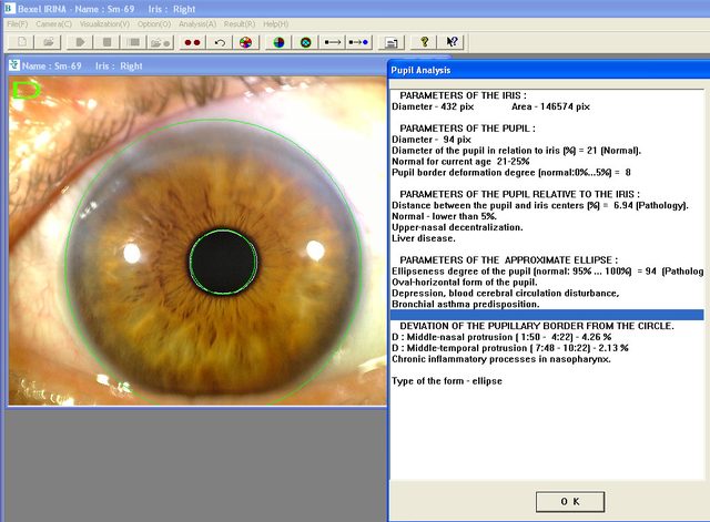 Virtual Bexel IRINA pupil analysis: an amber iris with the pupil outlined and a panel of iris, pupil and ellipse parameters.