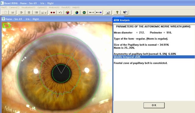 Autonomic nerve wreath analysis with the wreath traced on the iris and its measurements listed.