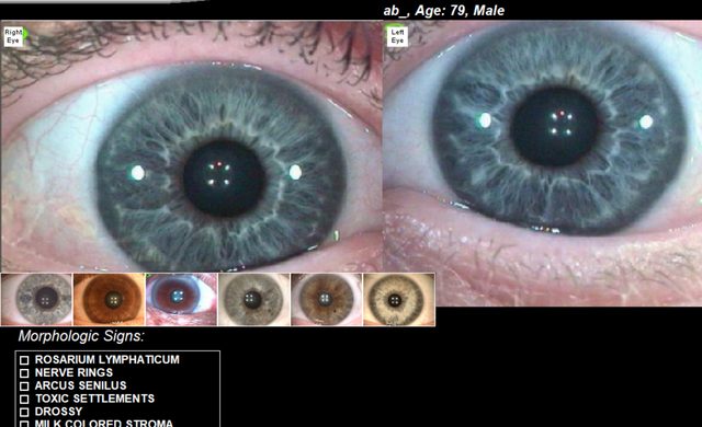 Both eyes above a row of reference iris images and a morphologic signs checklist.