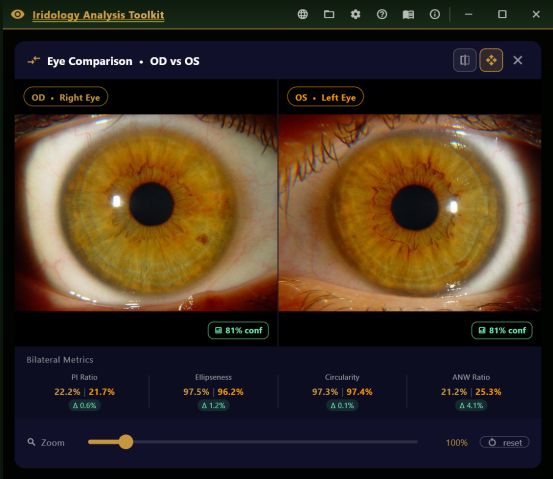 Eye comparison screen showing right and left eyes with bilateral pupil, ellipseness, circularity and nerve wreath ratios.